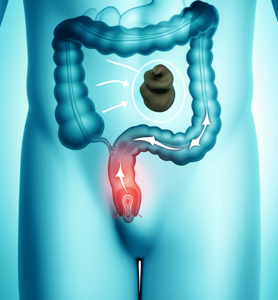 Person looking frustrated on a toilet, struggling with hard stools